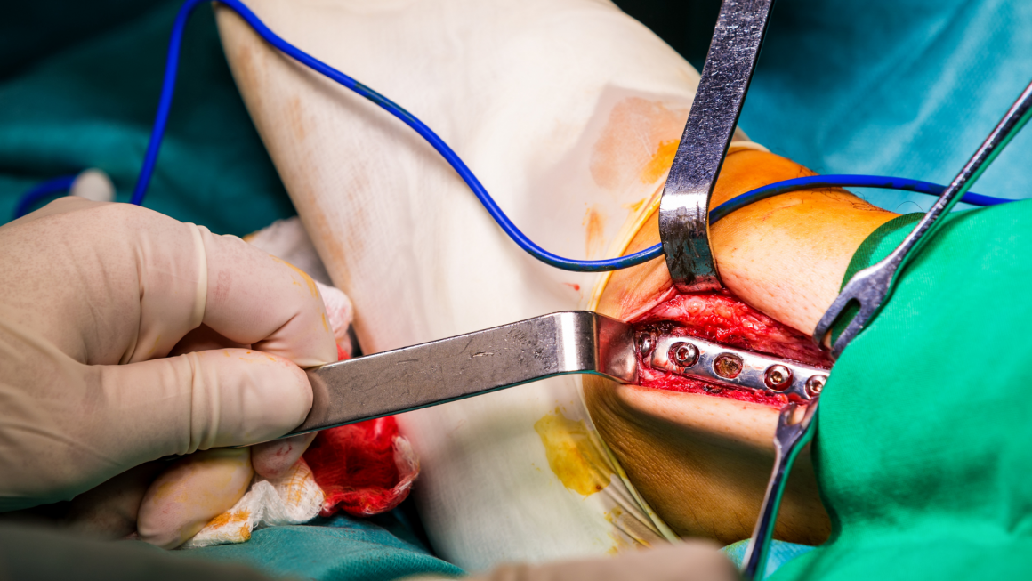 Orthopedic Implant Removal - Sama Hospital - A NABH Accredited 
