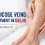 Varicose veins treatment in delhi
