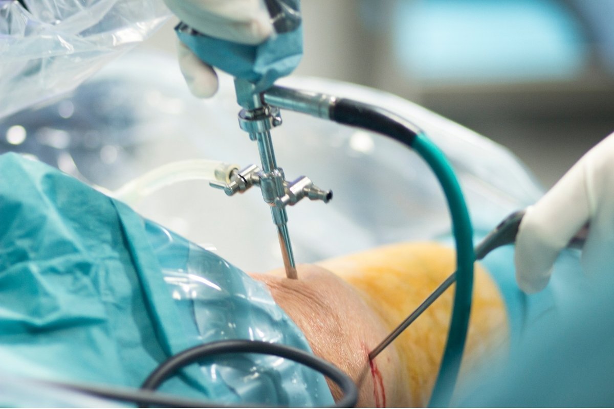 Arthroscopic ACL and meniscus knee surgery being performed at Sama Hospital, South Delhi