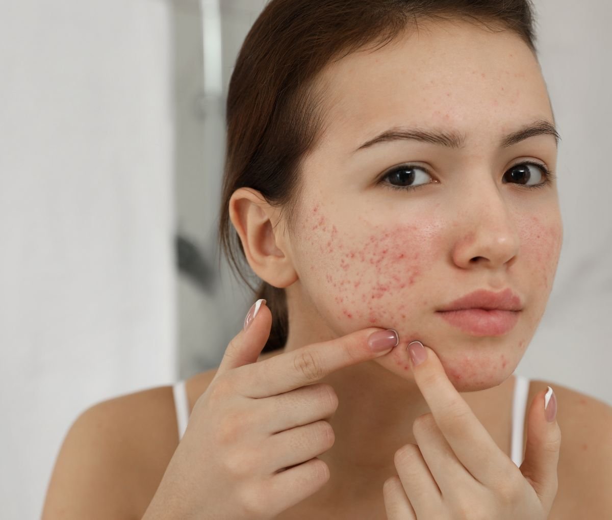Dermatologist assessing acne on a patient’s face at Sama Hospital, South Delhi