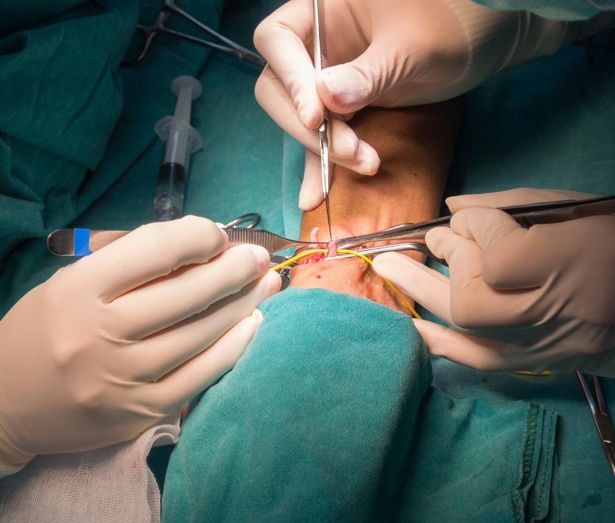 Arterio-venous fistula in the arm created for haemodialysis access at Sama Hospital, South Delhi