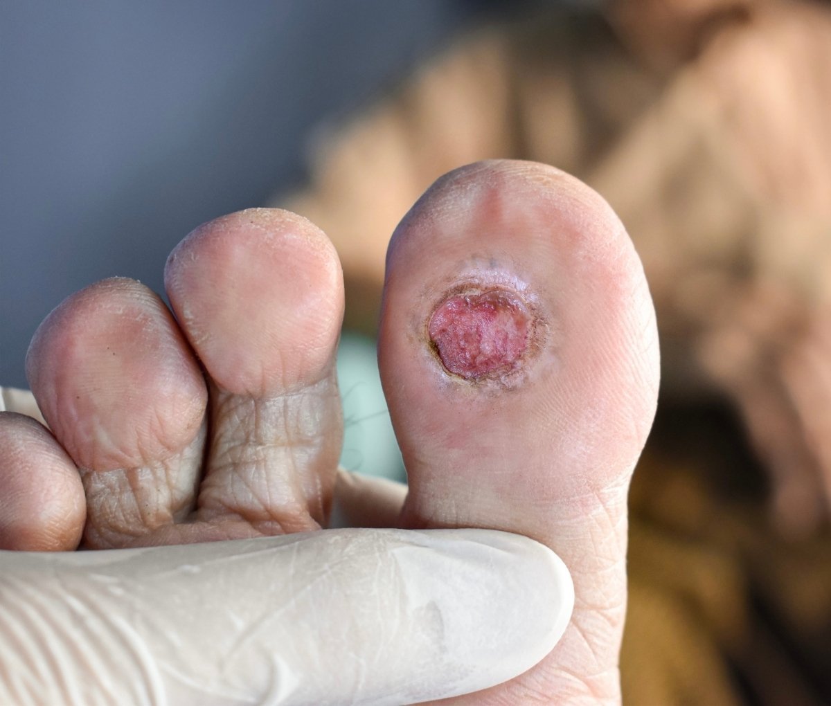 Clinical assessment and dressing of a diabetic foot ulcer at Sama Hospital, South Delhi
