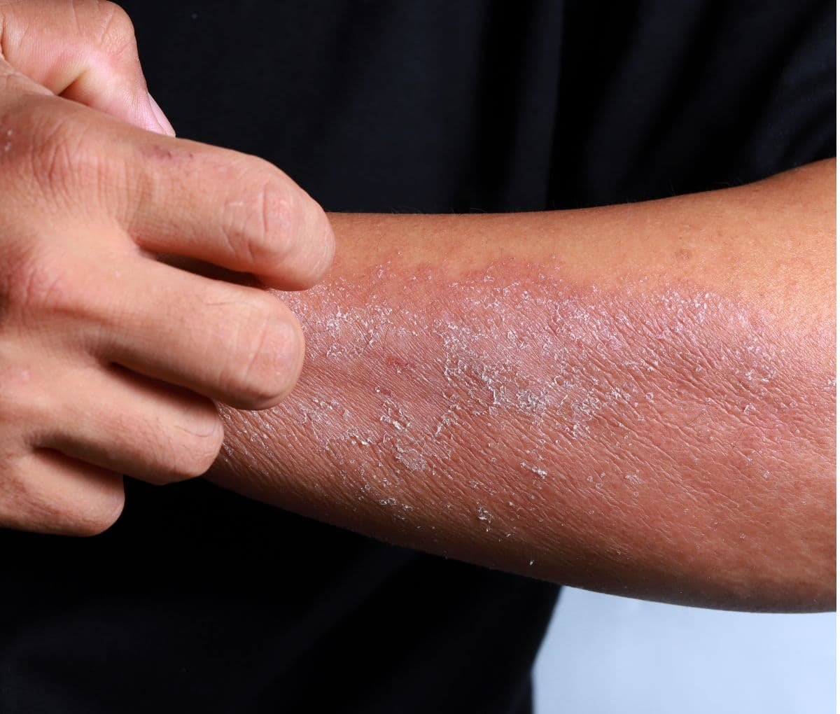 Dermatologist examining eczema on a patient’s skin at Sama Hospital, South Delhi