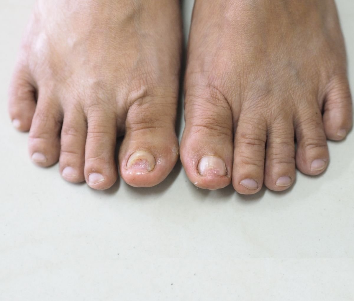 Dermatologist examining a thickened, discoloured nail affected by fungal infection at Sama Hospital, South Delhi