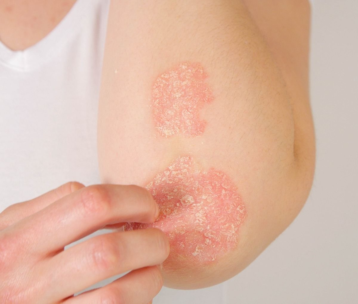Dermatologist examining psoriasis plaques on a patient’s skin at Sama Hospital, South Delhi
