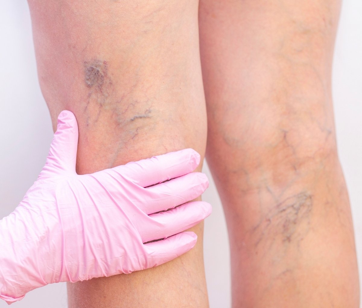 Laser treatment for spider veins on the legs at Sama Hospital, South Delhi